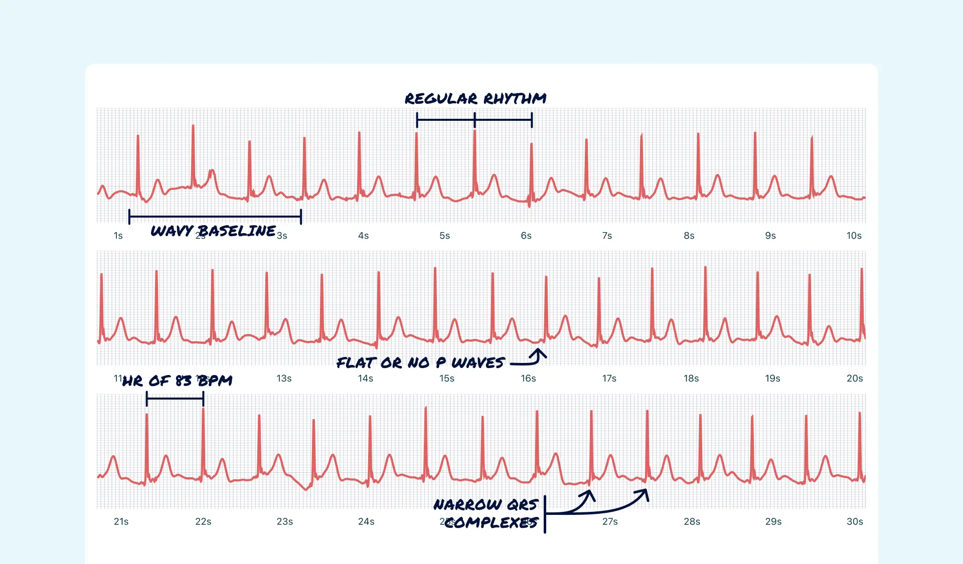 What does a junctional rhythm mean top sellers www jkuat ac ke
